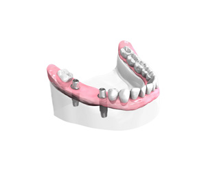 Remplacer plusieurs dents absentes ou abîmées à Pontault-Combault