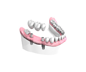 Remplacer plusieurs dents absentes ou abîmées à Pontault-Combault
